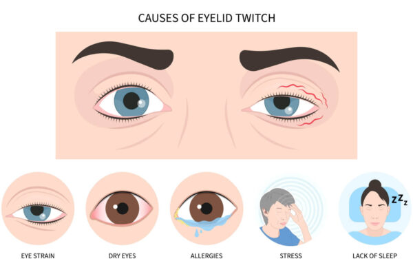 Why Do My Eyes Twitch Causes Of Eye Twitching And How To Manage It Ensocure 