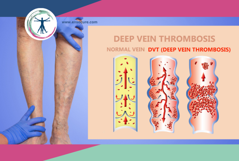 www.ensocure.com-deep vein thrombosis
