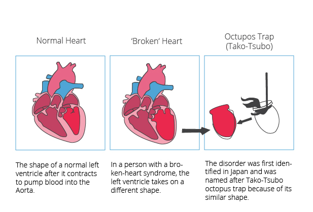 www.ensocure.com-broken heart syndrome
