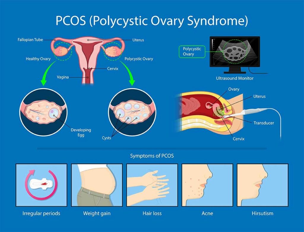 www.ensocure.com-PCOS IV therapy in Bangalore