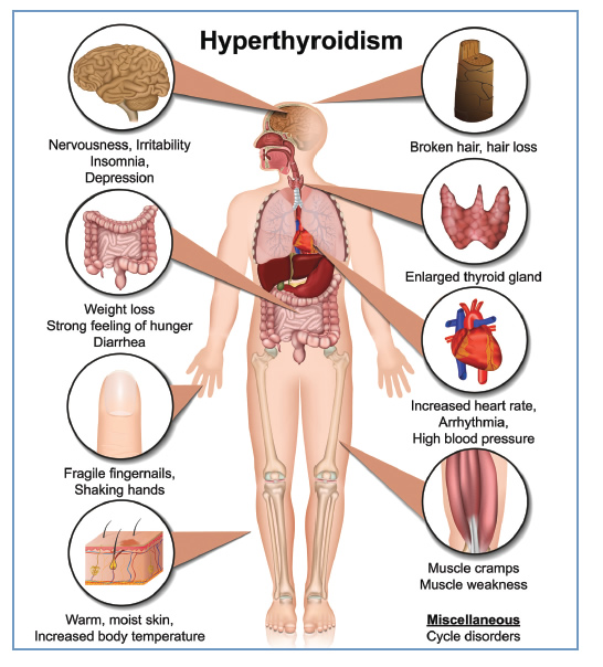 www.ensocure.com-hyperthyroidism