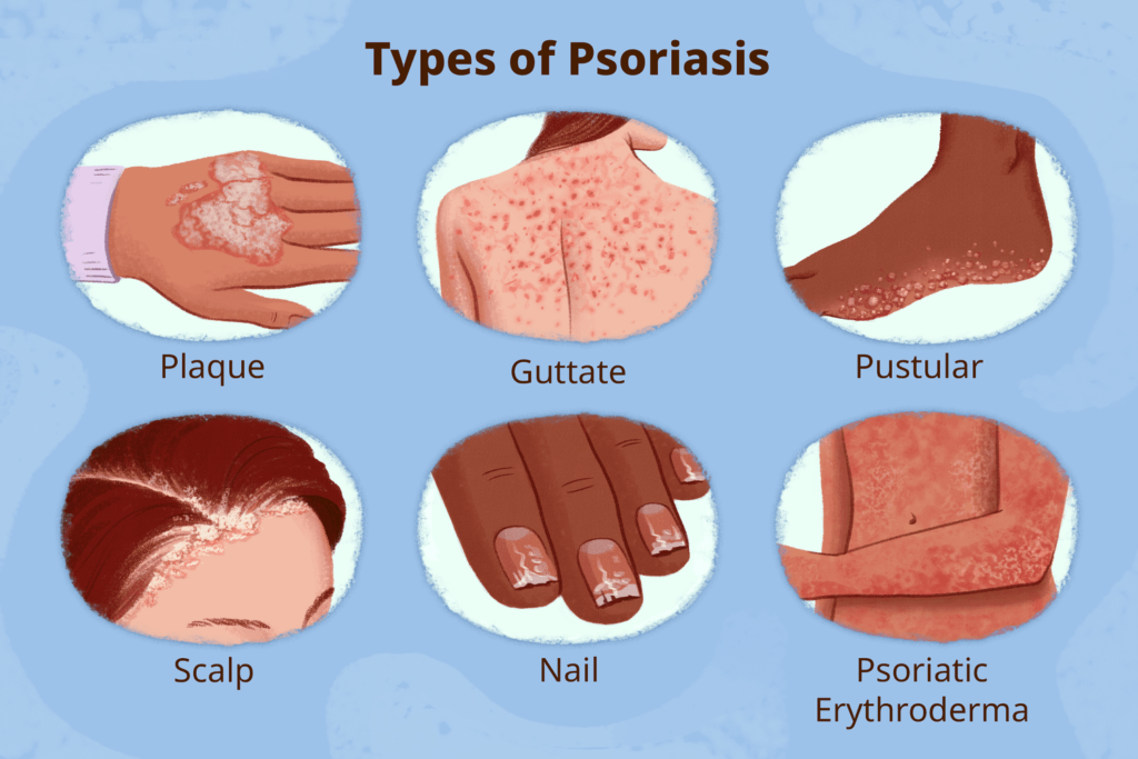 Psoriasis, Symptoms, Causes, Triggers, and Treatment - Ensocure