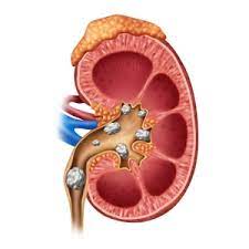www.ensocurfe.com-kidney stones