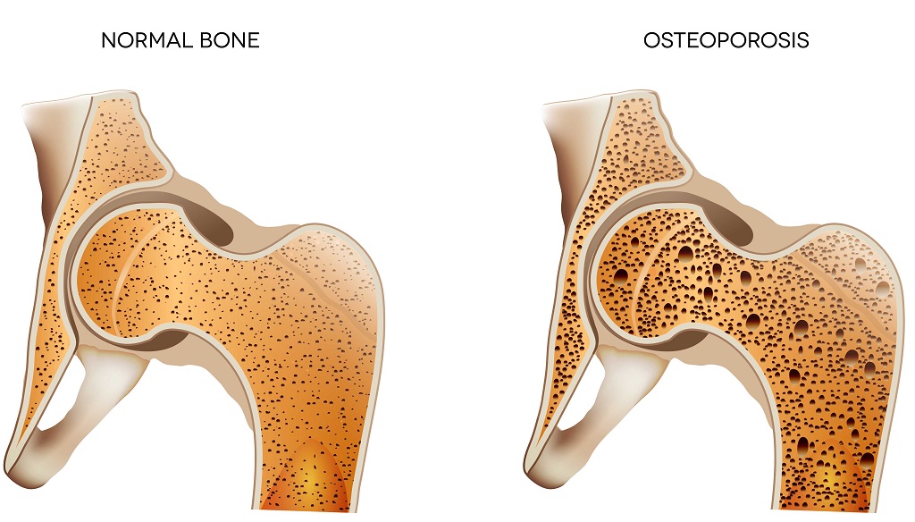 www.ensocure.com-osteoporosis
