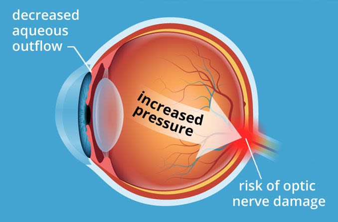 www.ensocure.com-hypertensive eye damage