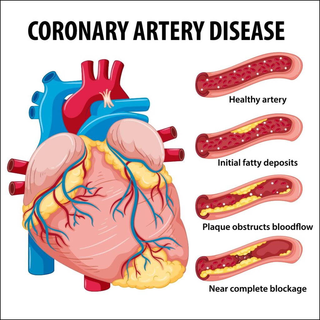 www.ensoccure.com-coronary artery disease